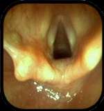 vocal chords
