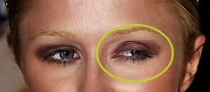 Lazy Eye